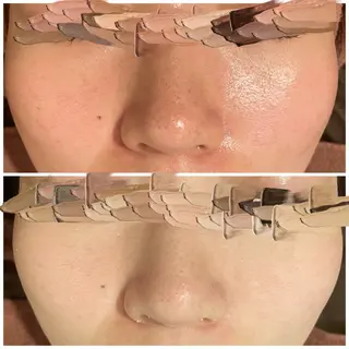 ニキビ特化型エステ 🍓最短で肌質改善のエステ・リラクイメージ