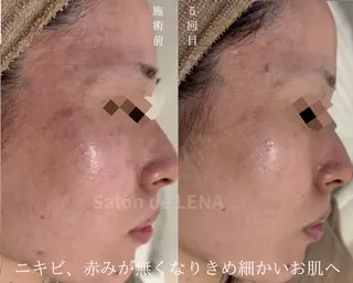 ハーブピーリング・毛穴ケア専門サロンSalon de LENA 栄店所属・ハーブピーリング専門 サロンドレナ　白藤のエステ・リラクイメージ