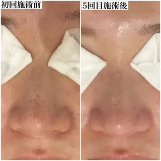 毛穴改善/脱毛 ネイル　川上久仁子のエステ・リラクイメージ