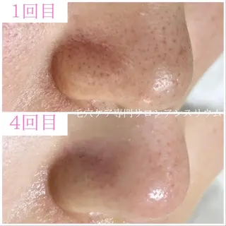 毛穴ケア専門サロンアンスリウム所属・茨城土浦 つくば毛穴 ケア専門サロンのエステ・リラクイメージ