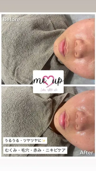 Meupニキビ専門店 背中/ハーブ/肌管理のその他イメージ