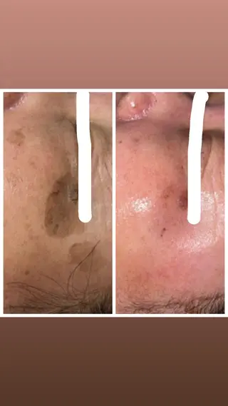 【ハーブピーリング】 Allumentのエステ・リラクイメージ