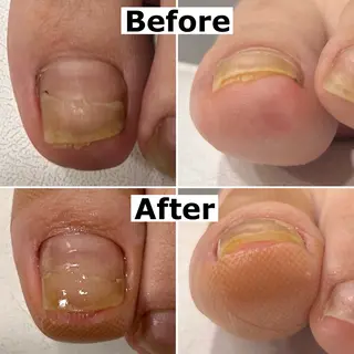 ネイル Mellow nail所属・巻爪無料モデル募集 ✨🦶MEGUMIのネイルデザイン