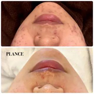 フェイシャル専門 肌質改善/プランスのエステ・リラクイメージ