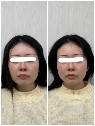 美容鍼×小顔矯正 ×美容整体　浜川泰仁のエステ・リラクイメージ