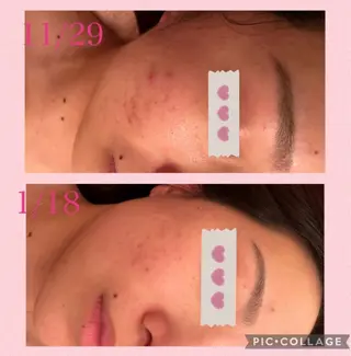 3/25迄ハーブ ピーリングBloomのエステ・リラクイメージ