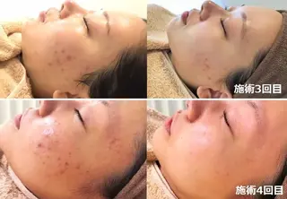 全身脱毛＆VIO脱毛 紹介率№1♪リナ♪のエステ・リラクイメージ