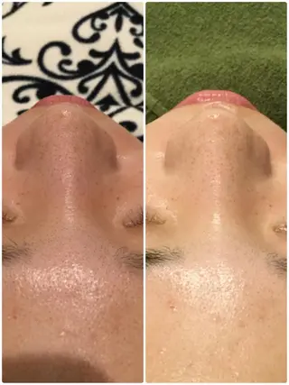 【リベルハーブピーリング認定店】敏感肌・美白脱毛専門店Dione立川店所属・Dione 立川店のエステ・リラクイメージ