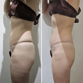 脂肪冷却 & 脱毛 AYUMIのその他イメージ