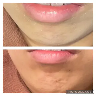 セミロング パーマ ヘアアレンジ メンズ キッズ ネイル マツエク・マツパ アイブロウ ニキビ特化型エステ 🍓最短で肌質改善のエステ・リラクイメージ