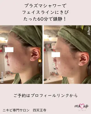 Meupニキビ専門店 背中/ハーブ/肌管理のその他イメージ