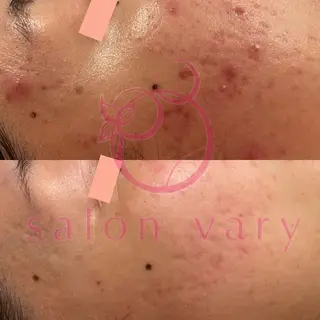 【ニキビ/肌管理】 salon varyのエステ・リラクイメージ