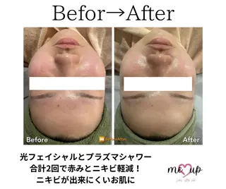 Meupニキビ専門店 背中/ハーブ/肌管理のその他イメージ