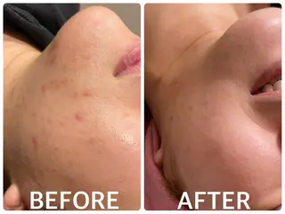 ハーブピーリング 🌿京橋のエステ・リラクイメージ