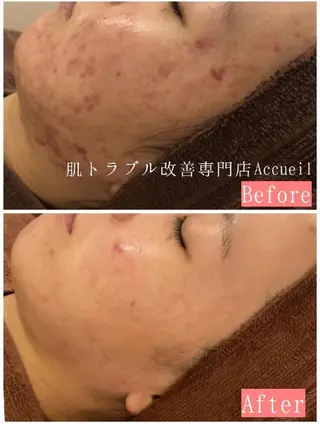 夏までに肌荒れ卒業 するサロン🌻のエステ・リラクイメージ