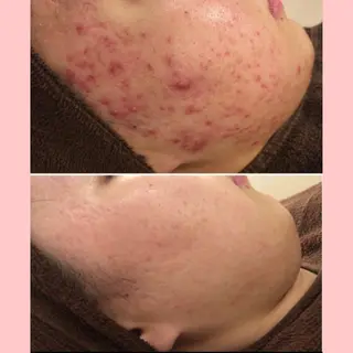 セミロング カラー パーマ ヘアアレンジ メンズ キッズ ネイル マツエク・マツパ アイブロウ 🔥3か月で肌革命 🔥ニキビ専門店のエステ・リラクイメージ