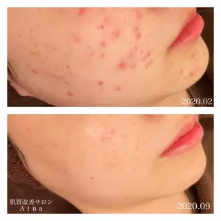 ミディアム カラー パーマ ヘアアレンジ メンズ キッズ ネイル マツエク・マツパ ニキビ跡専門サロン Ainaのエステ・リラクイメージ