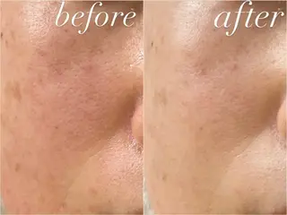 肌質改善|天王寺 For...はるかのエステ・リラクイメージ