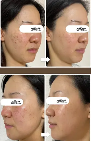 肌質改善&アロマサロンaffett.所属・澤井 千晴のエステ・リラクイメージ