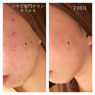 ミディアム カラー パーマ ヘアアレンジ メンズ キッズ ネイル マツエク・マツパ ニキビ跡専門サロン Ainaのエステ・リラクイメージ