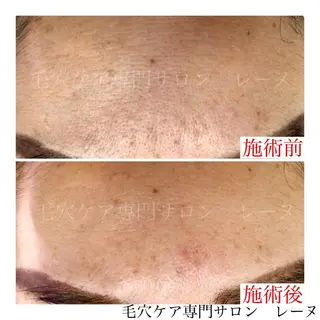 毛穴ケア専門サロン レーヌのエステ・リラクイメージ