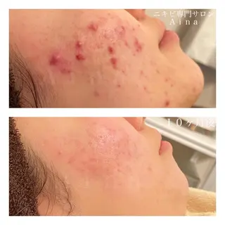 ショート カラー パーマ ヘアアレンジ メンズ キッズ ネイル マツエク・マツパ ニキビ跡専門サロン Ainaのエステ・リラクイメージ