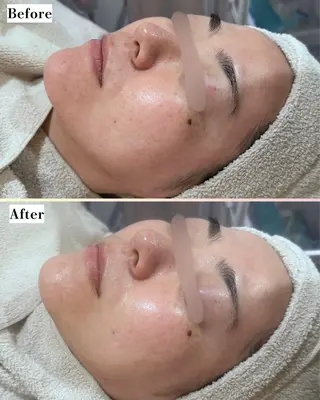 |ピーリング・毛穴| soina神楽坂のエステ・リラクイメージ