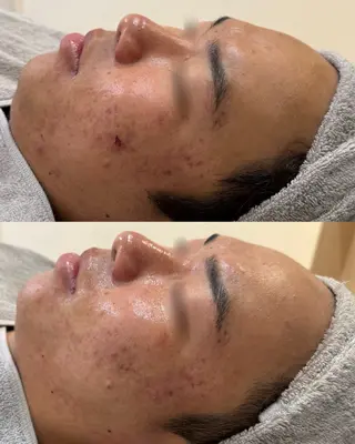 メンズ ニキビ・赤み・毛穴 |肌質改善専門サロンのエステ・リラクイメージ