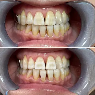 セルフホワイトニング Shineeのエステ・リラクイメージ