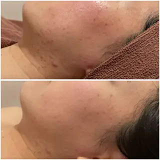 ニキビ特化型エステ 🍓最短で肌質改善のエステ・リラクイメージ