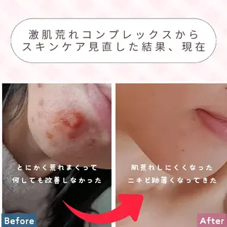 痩身ハーブピーリング 筋膜リリース☆B&Hのエステ・リラクイメージ