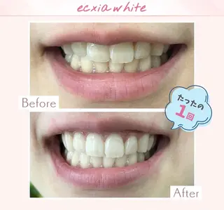 エクシアホワイト調布所属・umi❤︎ ホワイトニングのその他イメージ