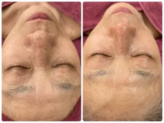 Chalon所属・REVI取扱・肌悩み 毛穴Chalonのエステ・リラクイメージ