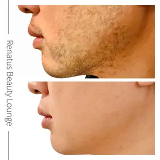 メンズ Renatus 脱毛/美肌/眉/痩身のエステ・リラクイメージ