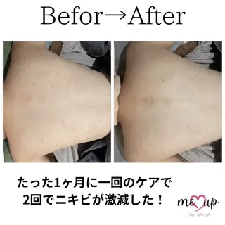 Meupニキビ専門店 背中/ハーブ/肌管理のその他イメージ