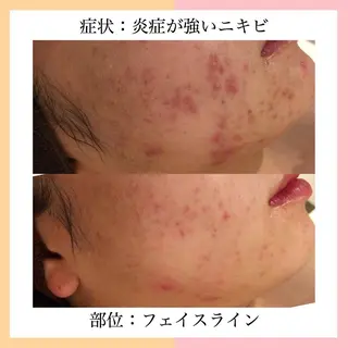 ロング カラー パーマ ヘアアレンジ メンズ キッズ ネイル マツエク・マツパ アイブロウ ニキビ特化型エステ 🍓最短で肌質改善のエステ・リラクイメージ