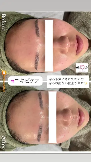 Meupニキビ専門店 背中/ハーブ/肌管理のその他イメージ