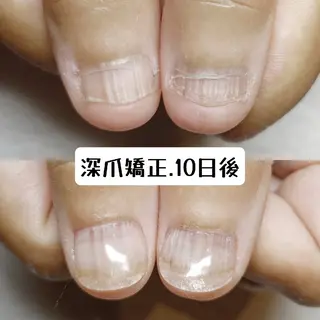 ネイル 深爪矯正/爪育成ケア manie nailのネイルデザイン