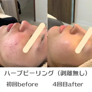 最速小顔・肌質管理 ❣️エスポワールのエステ・リラクイメージ