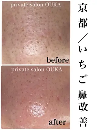private salon OUKA所属・OUKA脱毛 毛穴ケアフェイシャルのエステ・リラクイメージ