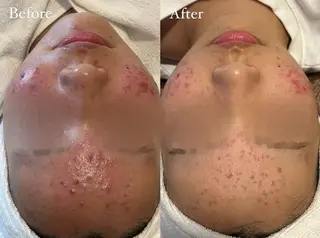 毛穴/ハーブピーリング 韓国肌管理Belle 高槻所属・韓国肌管理 Belleのエステ・リラクイメージ