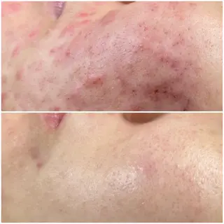 ニキビケア Moto rihi【モトリヒ】のエステ・リラクイメージ