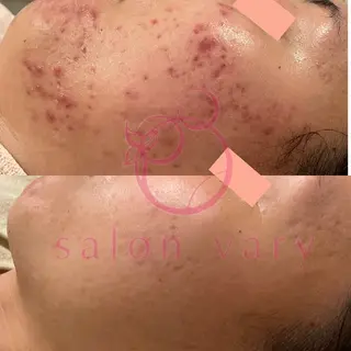 【ニキビ/肌管理】 salon varyのエステ・リラクイメージ