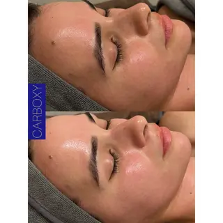 ☆痩身/小顔☆ ハイパーナイフexのエステ・リラクイメージ