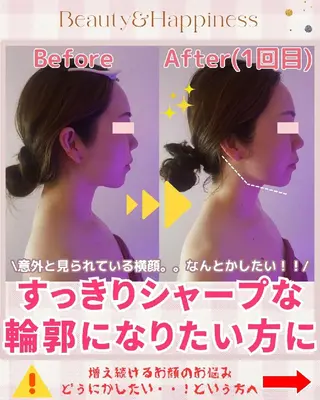 痩身ハーブピーリング 筋膜リリース☆B&Hのエステ・リラクイメージ