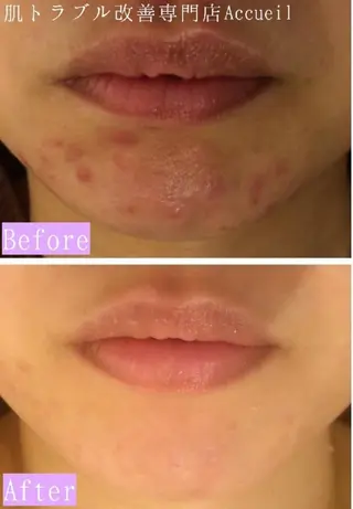 ニキビ跡改善専門🔥 医療にはできない改善のエステ・リラクイメージ