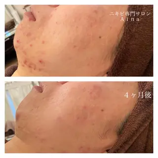 セミロング カラー パーマ ヘアアレンジ メンズ キッズ ネイル マツエク・マツパ ニキビ跡専門サロン Ainaのエステ・リラクイメージ