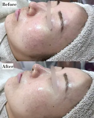 |ピーリング・毛穴| soina神楽坂のエステ・リラクイメージ