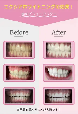 エクシアホワイト長野店所属・セルフホワイトニング エクシア長野店のその他イメージ