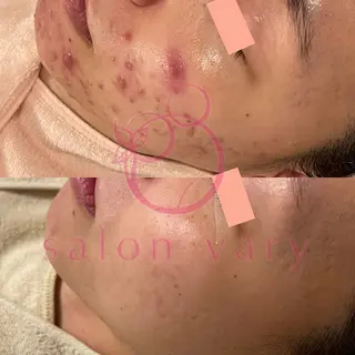 【ニキビ/肌管理】 salon varyのエステ・リラクイメージ